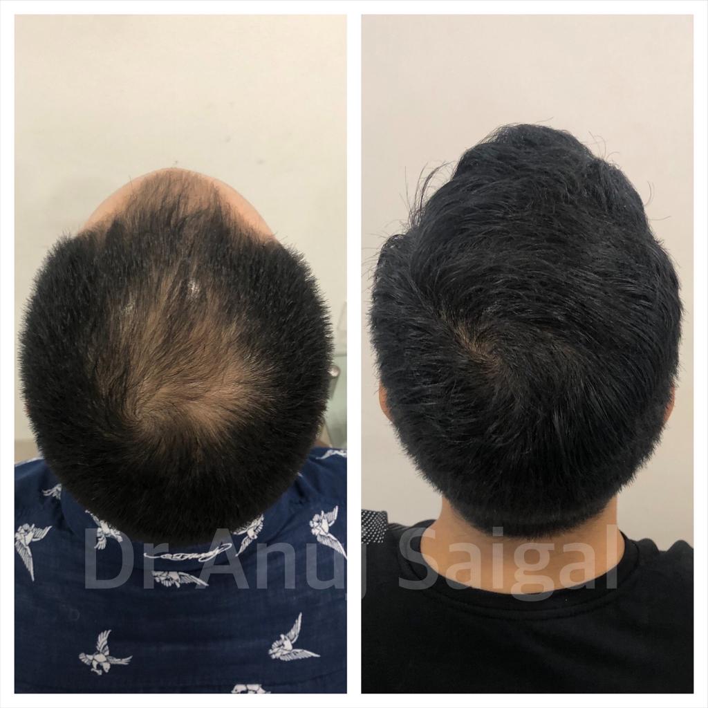 Best hair transplant doctor in delhi